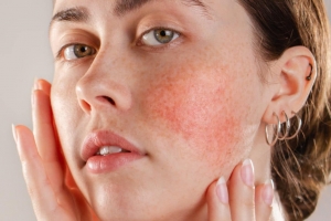 The Ins and Outs of Acne Rosacea